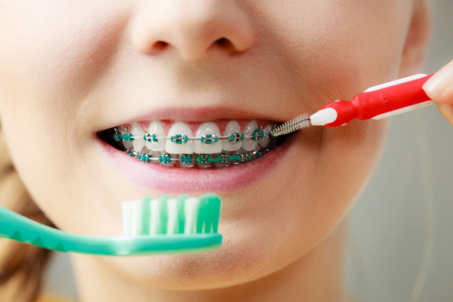 Aparelhos para os dentes: qual, quando e como usar